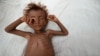 A malnourished boy lies on a bed outside his family's hut in al-Tuhaita district of the Red Sea province of Hudaydah, Yemen, Sept. 26, 2016.